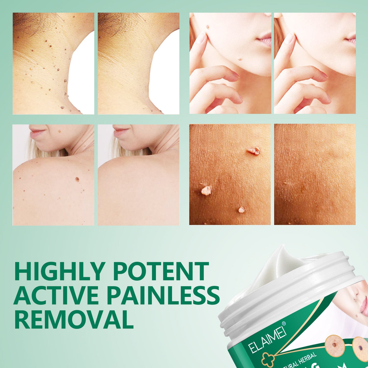 ELAIMEI - 100% Natural Herbal-Skin Tag Remover Cream-Safe-Painless and Reliable