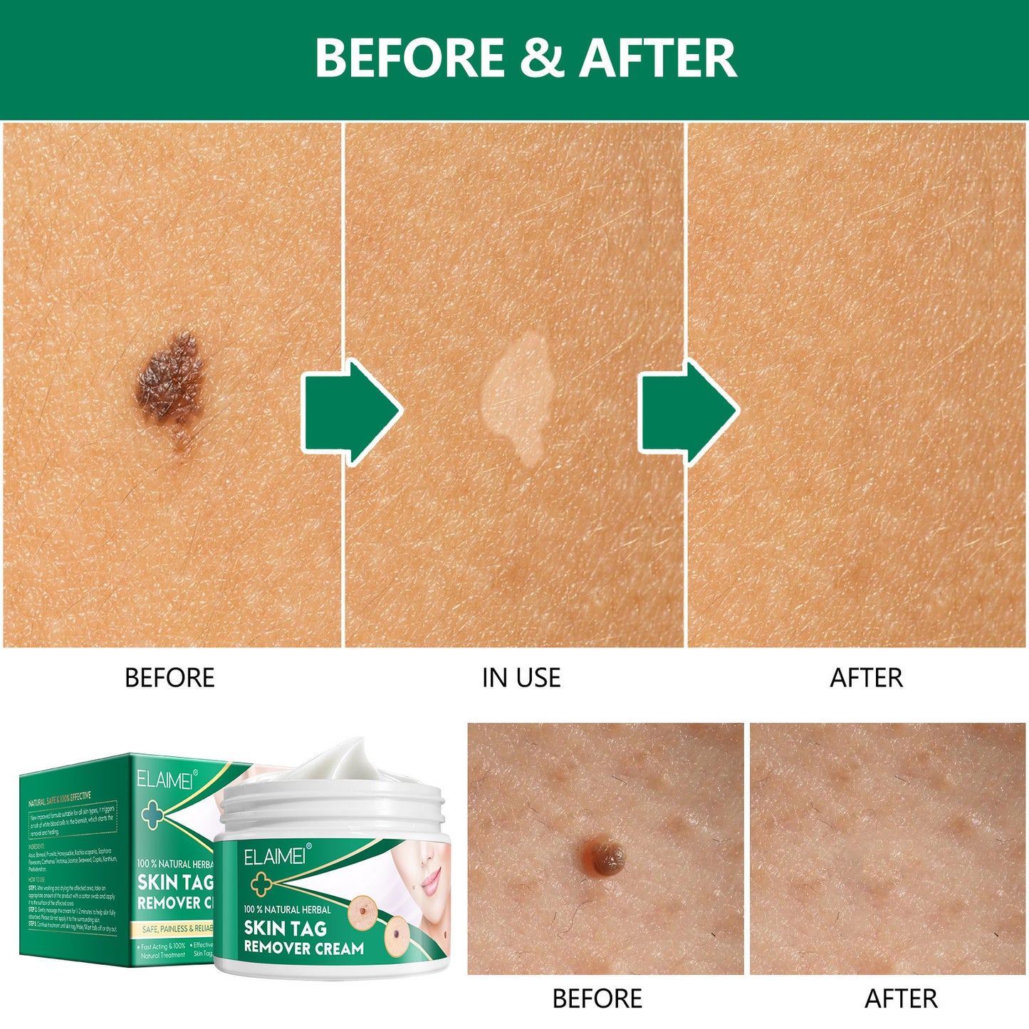 ELAIMEI - 100% Natural Herbal-Skin Tag Remover Cream-Safe-Painless and Reliable