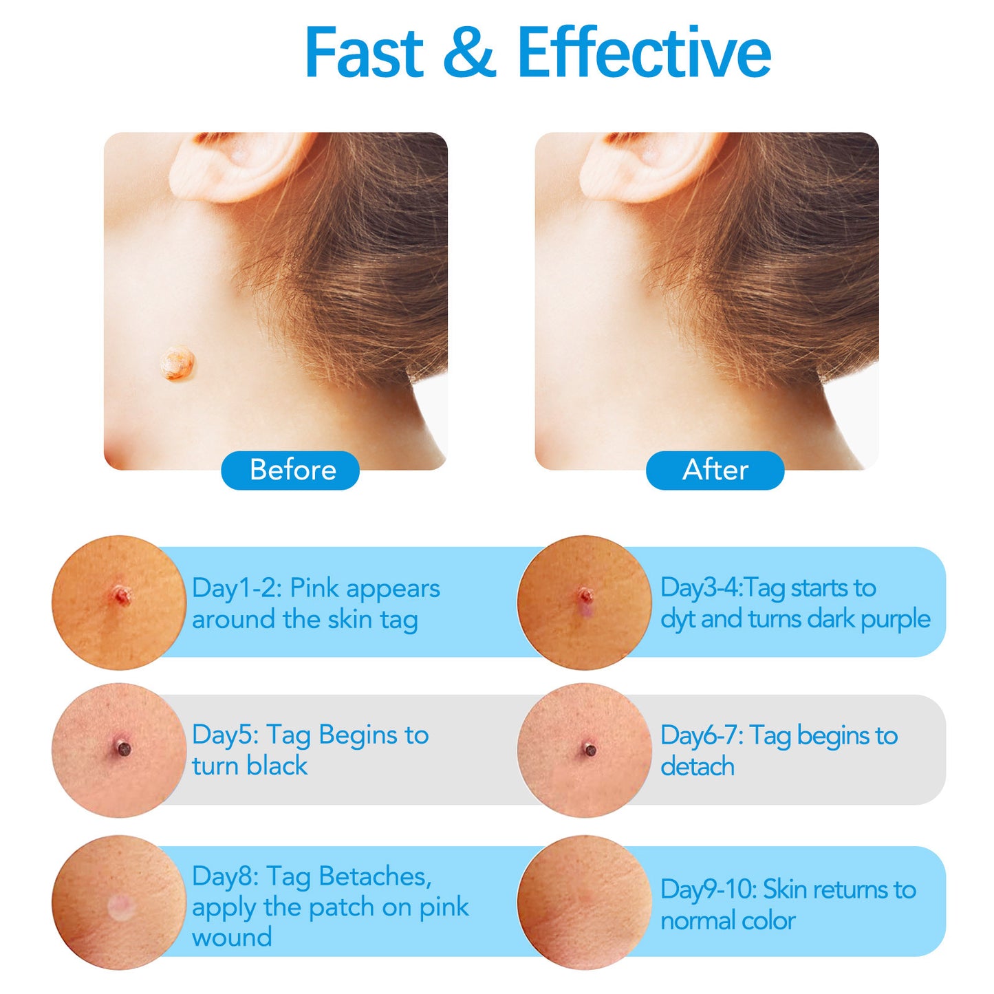 ELAIMEI - Skin Tag Removal Kit-2 in 1 -Painless and Easy Remover at Home