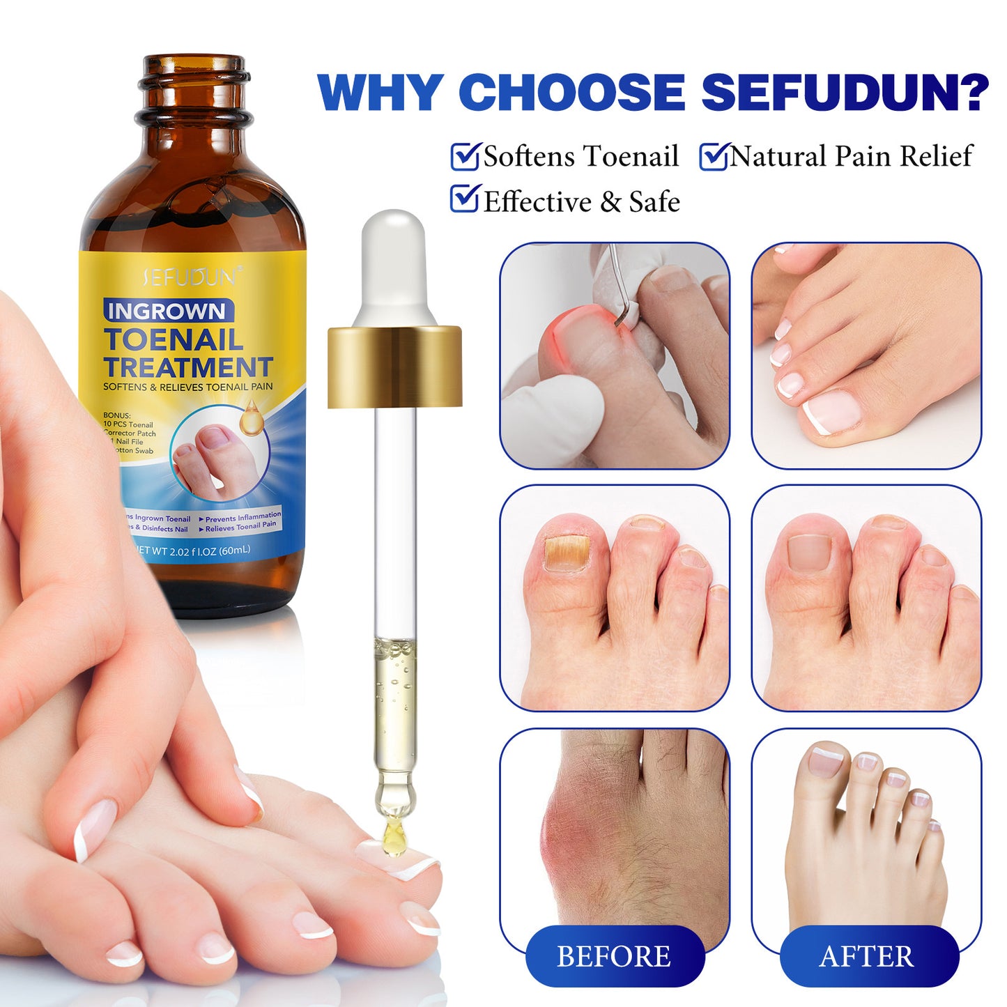 SEFUDUN - Ingrown Toenail Treatment Softens and Relieves Toenail Pain