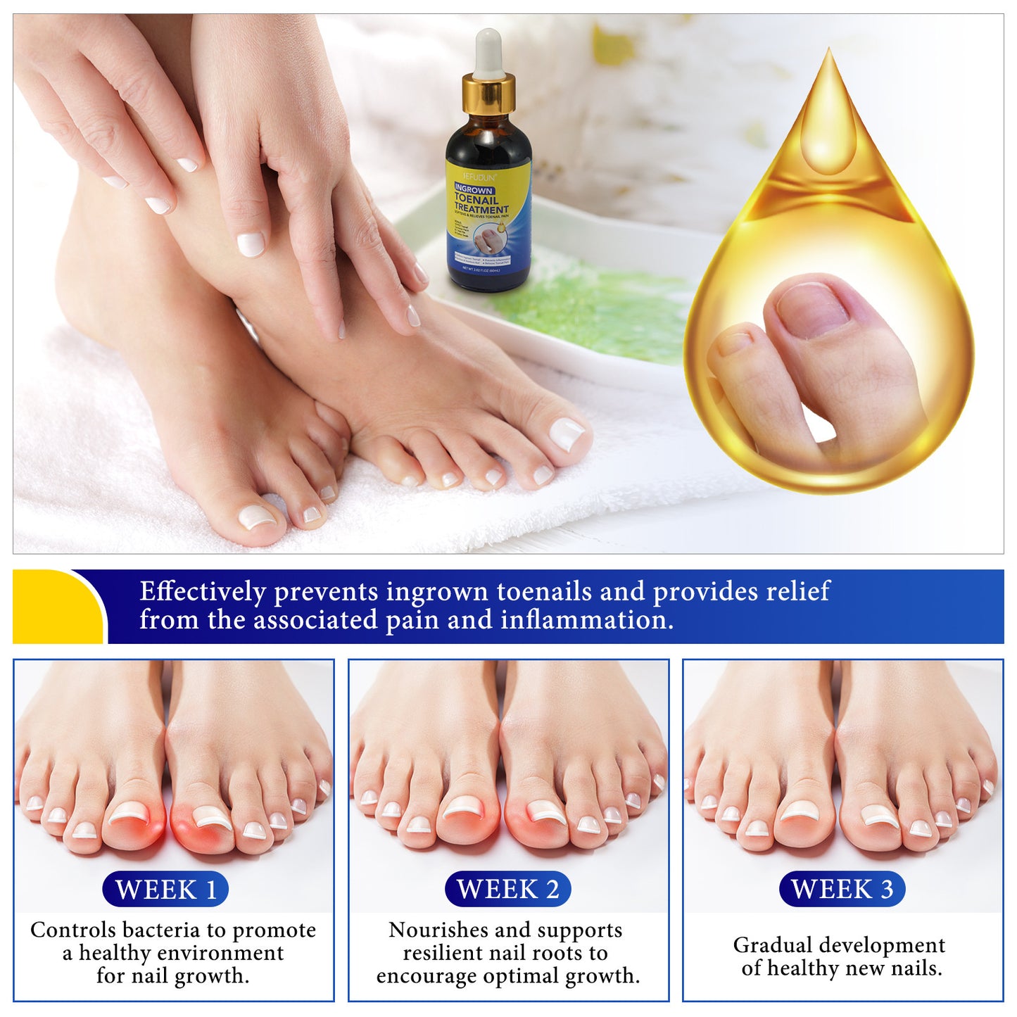 SEFUDUN - Ingrown Toenail Treatment Softens and Relieves Toenail Pain