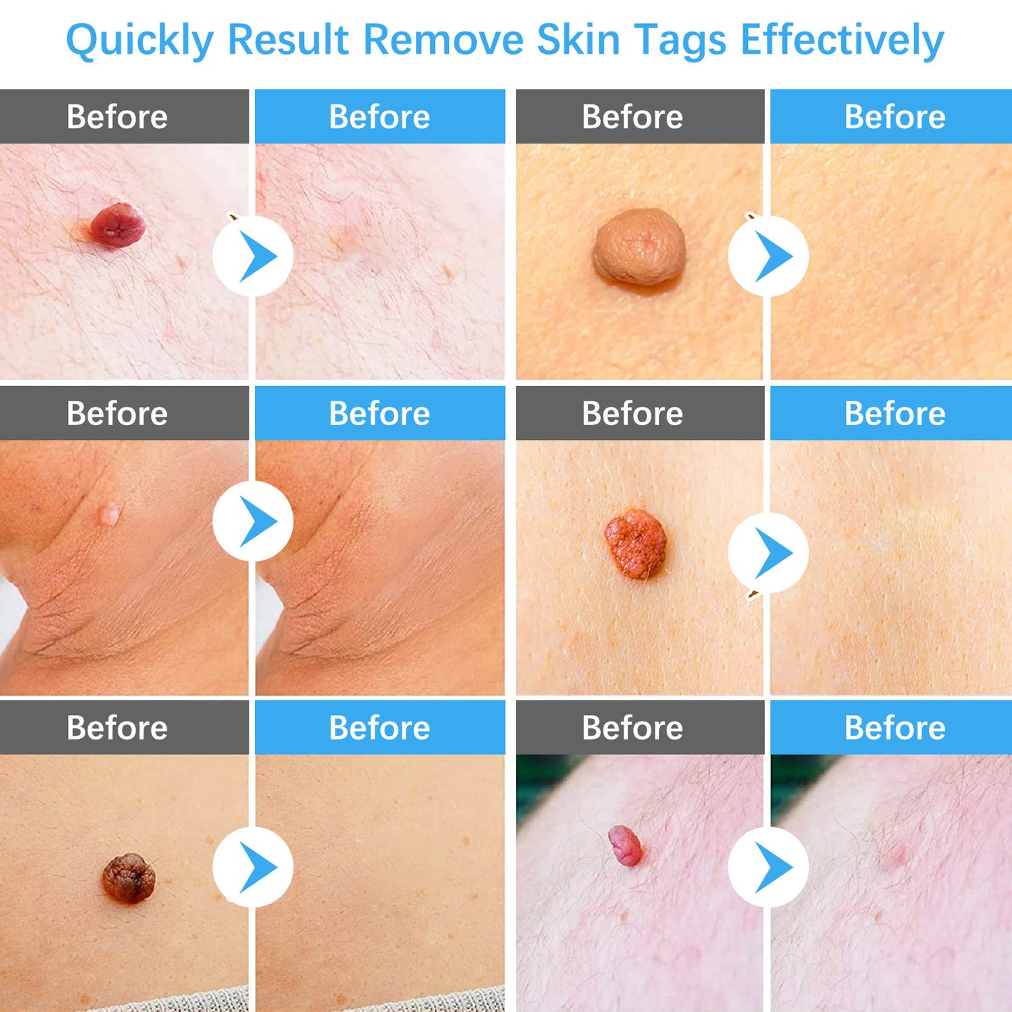 ELAIMEI - Skin Tag Removal Kit-2 in 1 -Painless and Easy Remover at Home